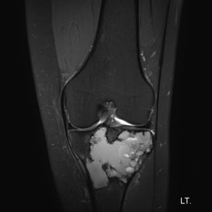 MRI image: the tumor can be seen in white in my left tibia bone