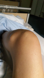 Small lump on the left of my knee is part of the tumor