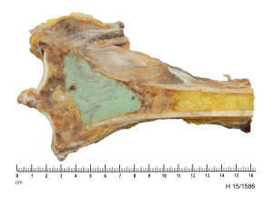 Upper tibia bone 
